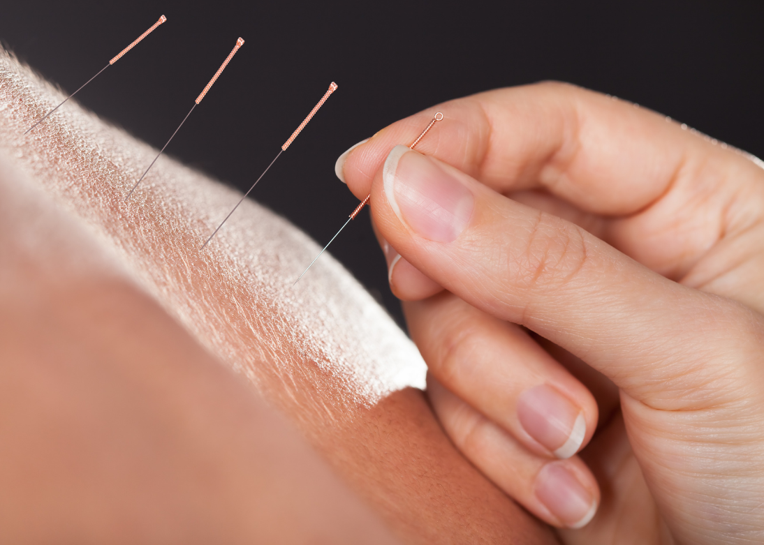 Acupuncture Treatment